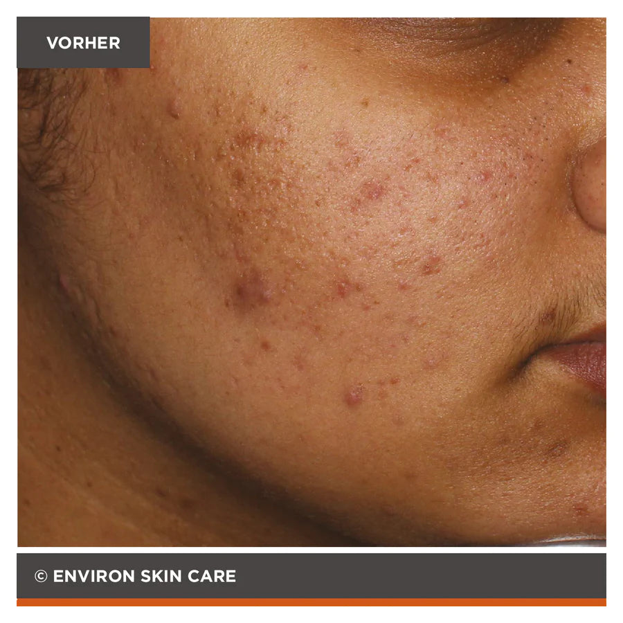 ENVIRON - Focus Care Clarity+ Botanical Infused Sebu-Spot Blemish Gel